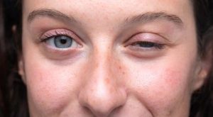 Best Myasthenia Gravis surgery in delhi